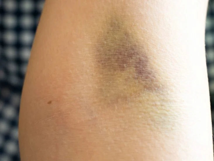 How to Avoid Blowing a Vein