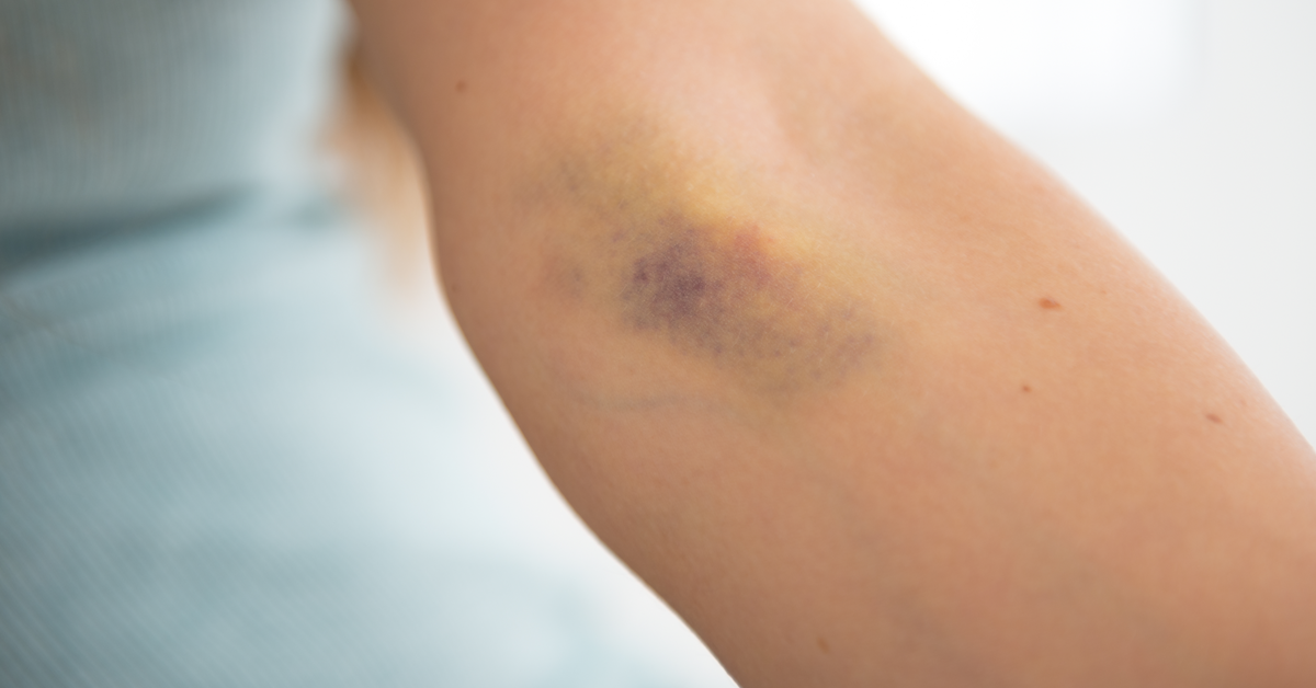 How to Master Cannula Insertion