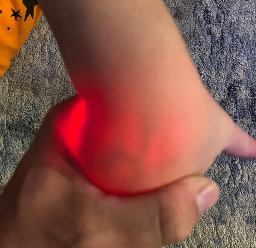 Customer photo, red light on a child's arm